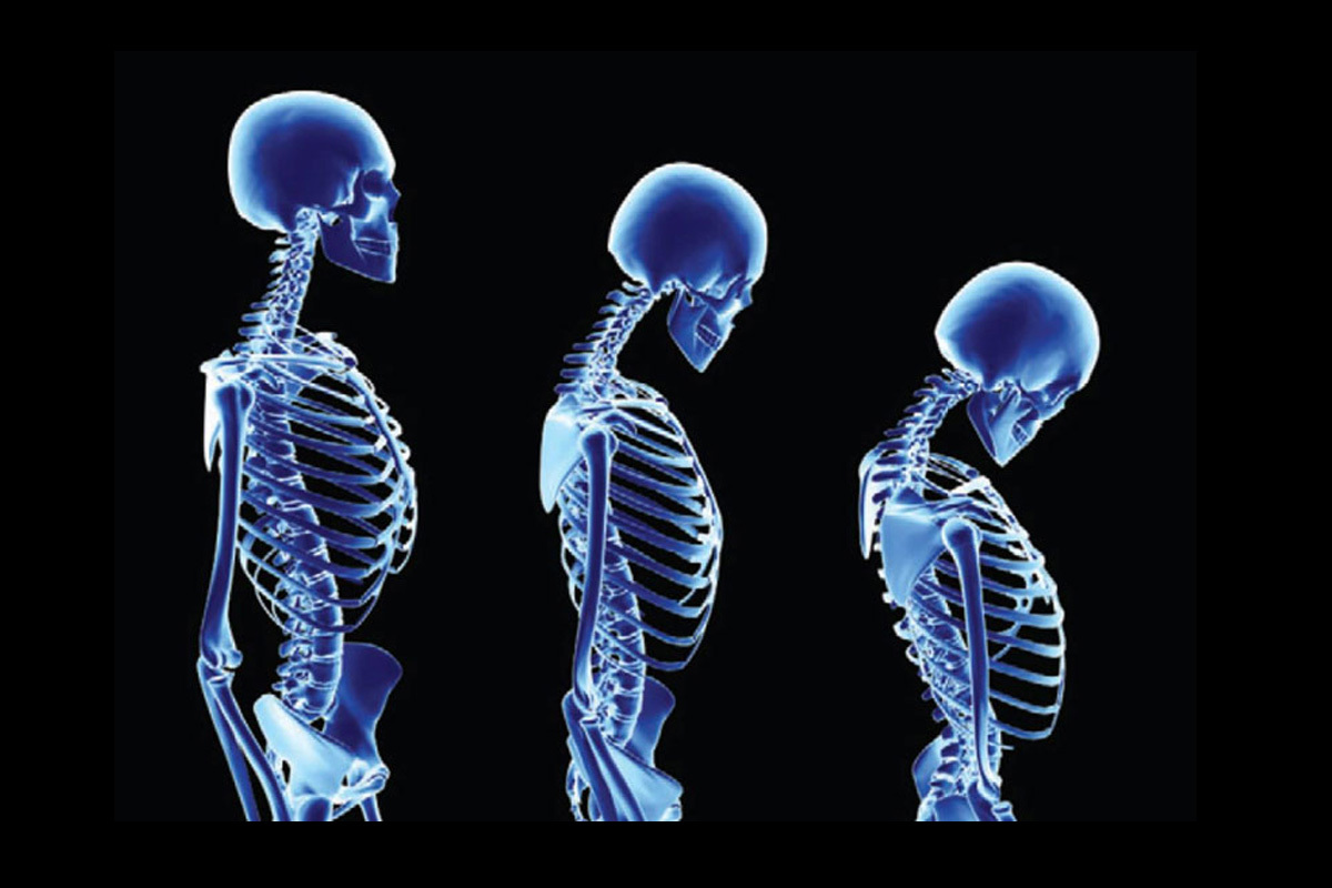 muškarci: da li vam je poznat rizik od osteoporoze kojem ste izloženi, Zdravlje i prevencija, muško zdravlje, magazin